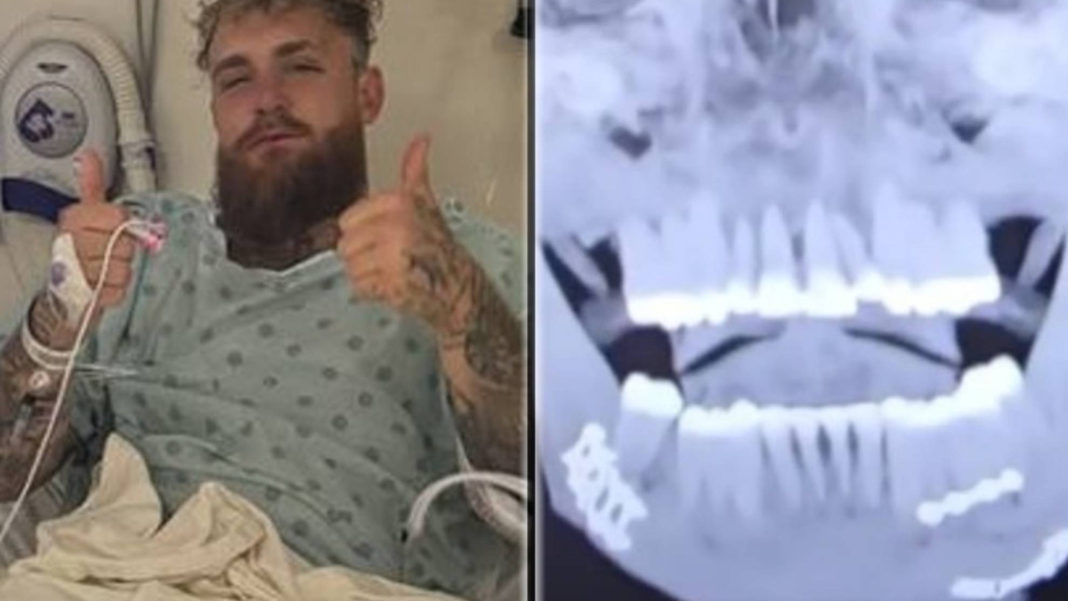 Así se le quedó la cara a Jake Paul tras partirle la mandíbula Anthony Joshua