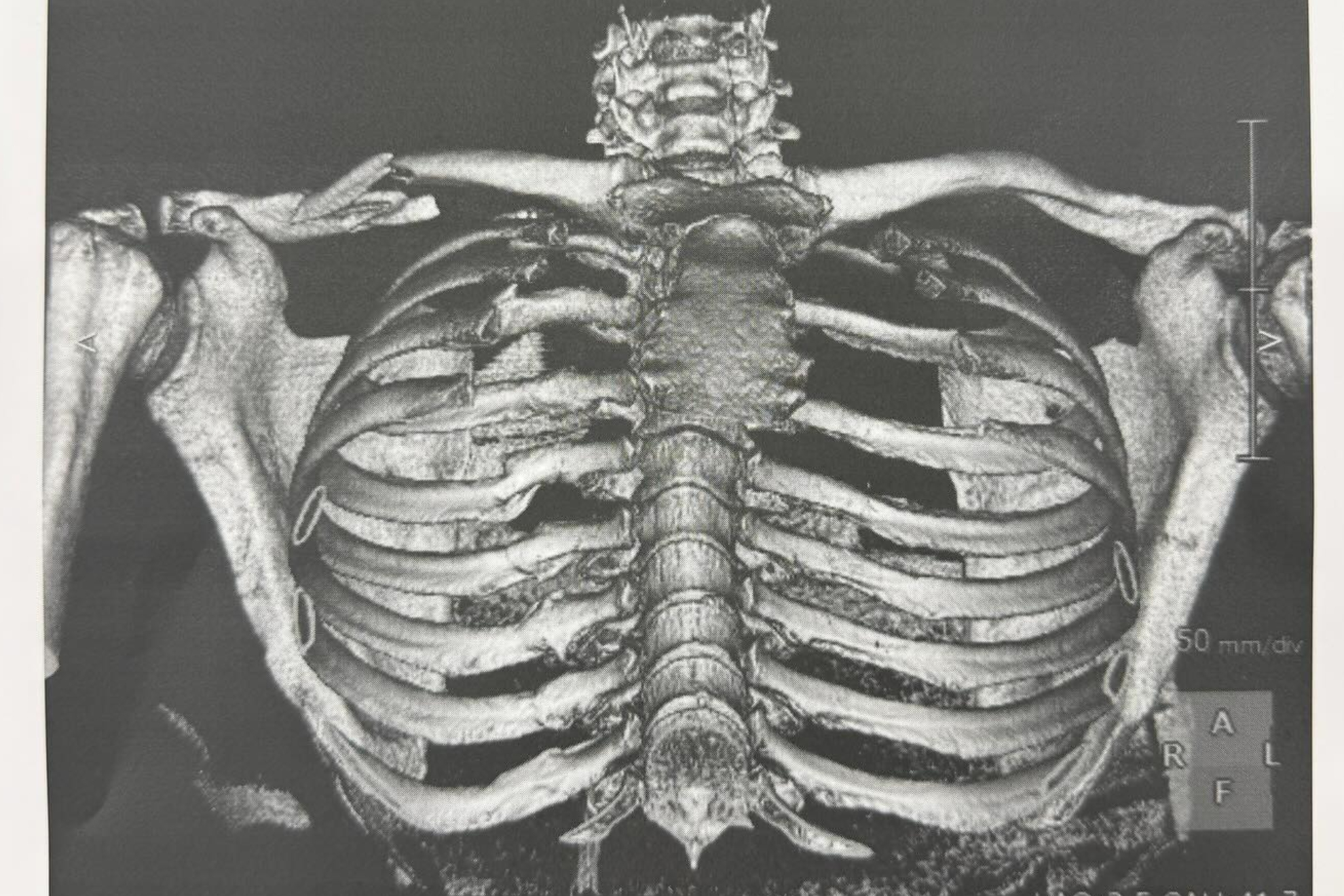 La radiografía de Martín en la que se ve la fractura en la clavícula.